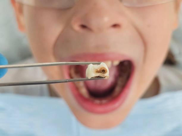Best Emergency Broken Tooth Repair in , UT